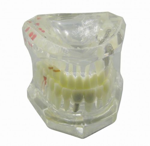 Dental Implant Disease Teeth Model With Restoration G018