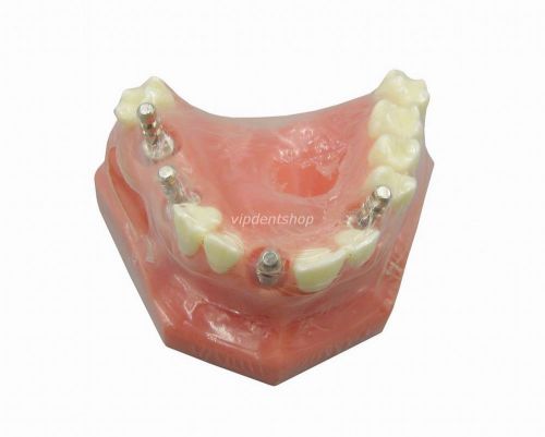 Dental Study Teaching Model European Implant Teeth Model G092