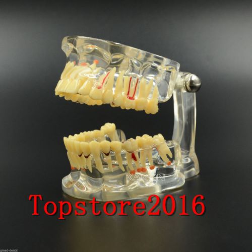 2016 Dental Study Tooth Transparent Adult Pathological &amp; Disease Teeth Model