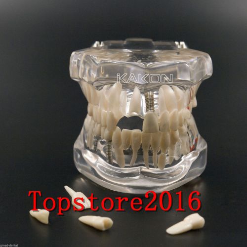 2016 Dental Implant Study Analysis Demonstration Teeth Model with Restoration