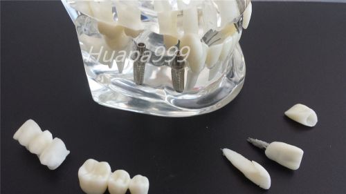 2015 Dental Implant Disease Teeth Model with Restoration &amp; Bridge Tooth