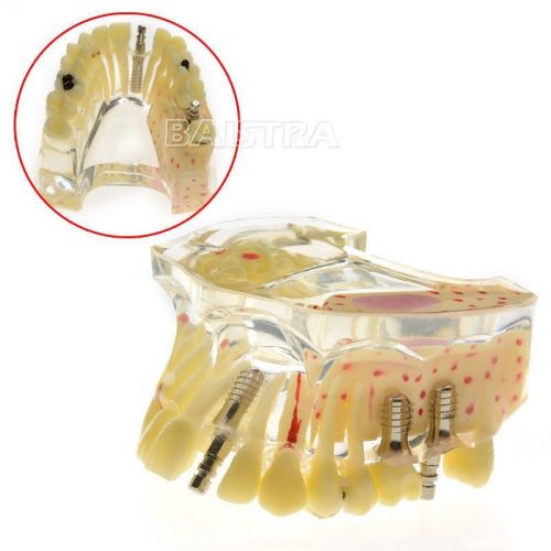 Dental Implant Study Teeth Model Osteoporosis and Caries 2007