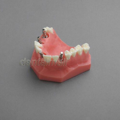 Dentalmall Dental Model #2012 01 - Upper Jaw Implant Model (Red)