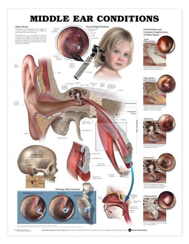 MIDDLE EAR CONDITIONS, LAMINATED ANATOMICAL CHART, 20 X 26