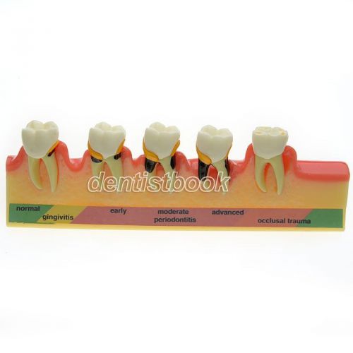 Dental Periodontal Disease assort Tooth Typodont Study Teaching Model Teeth 4010