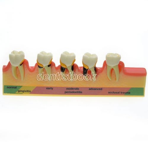 Dental periodontal disease assort tooth typodont study teaching model teeth 4010 for sale