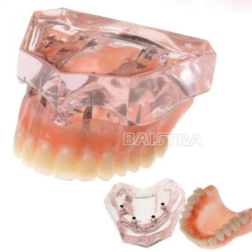 Dental Overdenture Inferior with 4 Implants Restoration Teeth Teach Model 6001