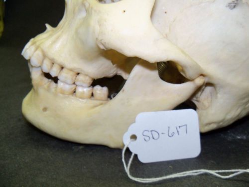 Real Human Skull, Antique, Medical Study,Skeleton, Bones,Teeth * FREE SHIPPING *