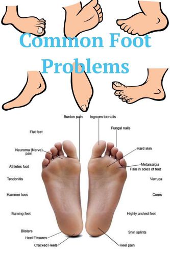 Podiatry Poster (24&#039;&#039; x 36&#039;&#039;) - Common Foot Problems