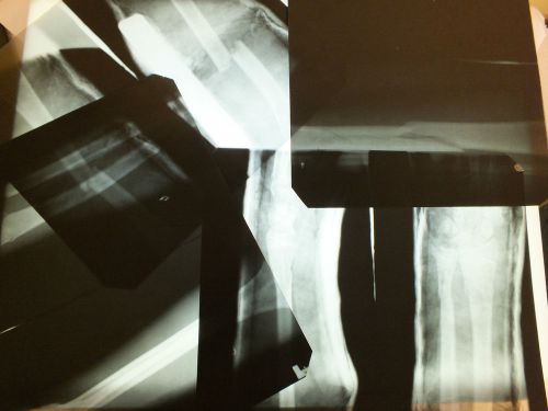 ORIGINAL VINTAGE 1930&#039;S broken bones arm legs X-RAY ODDITY 5 X-RAY&#039;S Lot #5