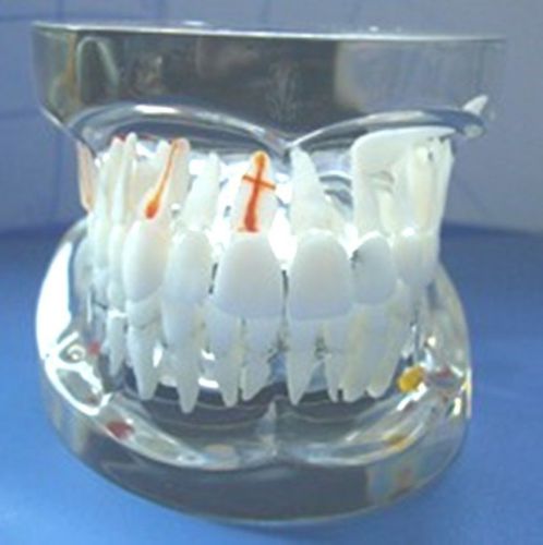 Dental Adult Pathology Model Upper Lower Jaw Set ABS Black Articulator NEW