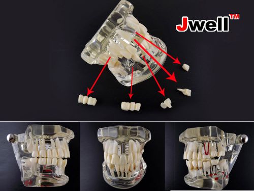 Dental implant disease teeth model with restoration w/ bridge tooth for sale