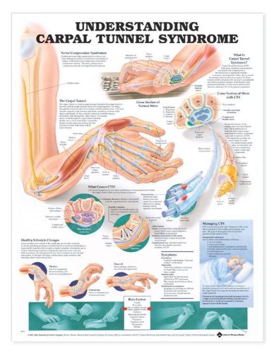 UNDERSTANDING CARPAL TUNNEL SYNDROME, LAMINATED ANATOMICAL CHART, 20 X 26