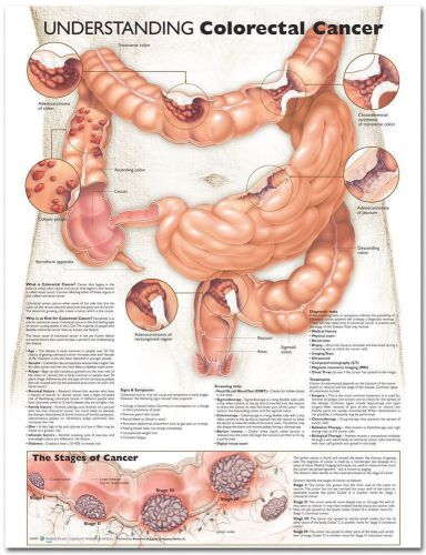 UNDERSTANDING COLORECTAL CANCER, LAMINATED ANATOMICAL CHART, 20 X 26