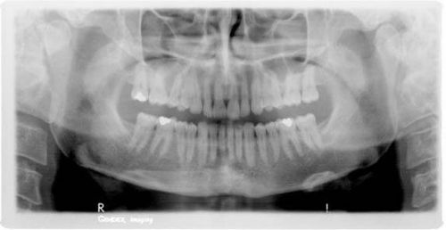 Panoramic Phosphor 15 x 30 cm dental