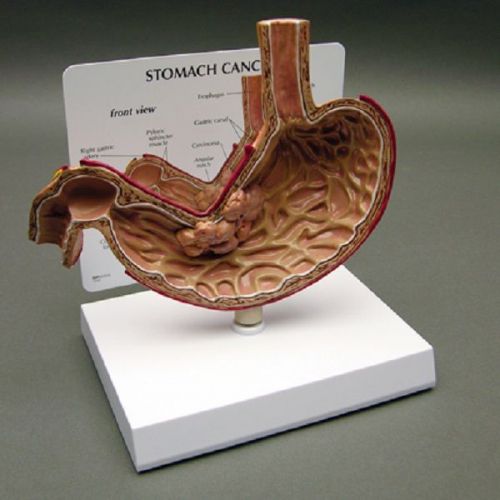 NEW Anatomical Stomach Cancer Model w/ Graphics Card OVERSTOCKED