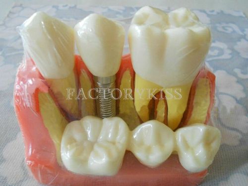 Dental Implant Analysis Crown Bridge Display Teeth Model Mouth Teach Model MUK