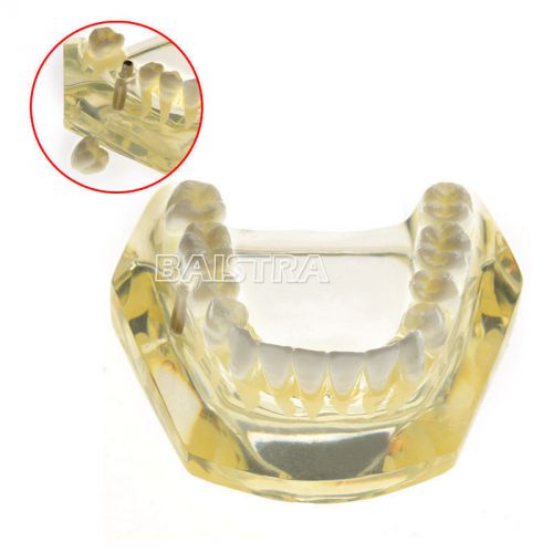 Dental Teeth Implant Study Model 1 Implant And Removable 3 Crown #2010-I