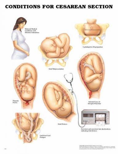 Conditions for Cesarean C Section * Anatomy Poster * Anatomical Chart Comp.