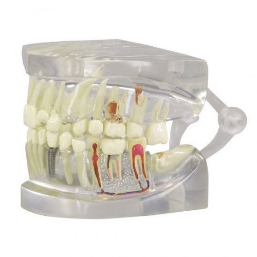 NEW GPI Anatomical Clear Human Jaw 2 Sided Healthy and Diseased Teeth Model 2861