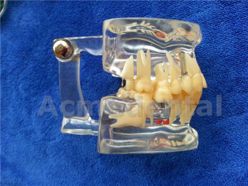 Promotion 1 x Dental Implant Disease Pathological Extrusion Missing Teeth Model
