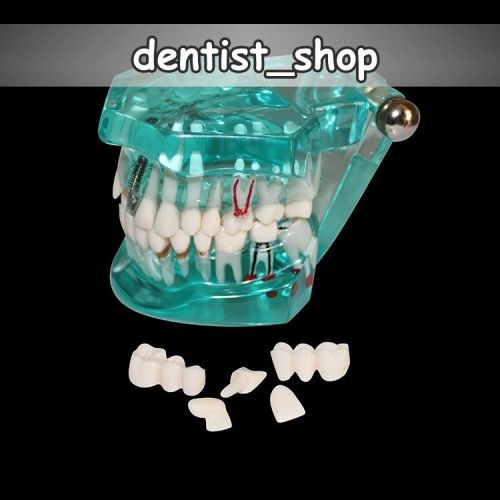 Dental Implant Study Analysis Demonstration Teeth Model