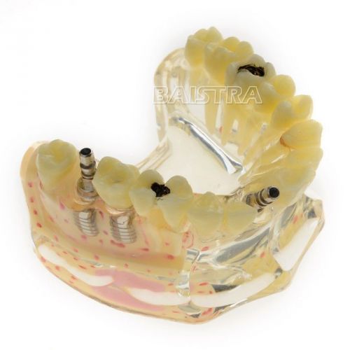New Dental Study Teaching Model Teeth Implant Model Osteoporosis &amp; Caries 2007