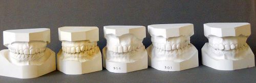 5 Plaster False Teeth Sets Customer Molds 1970s  Heres Smiling At You