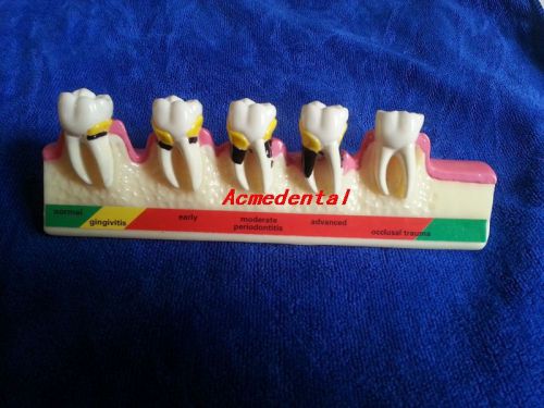 1 Pc Dental Teeth Model Periodontal Disease Assort Tooth Teach Model Free Ship