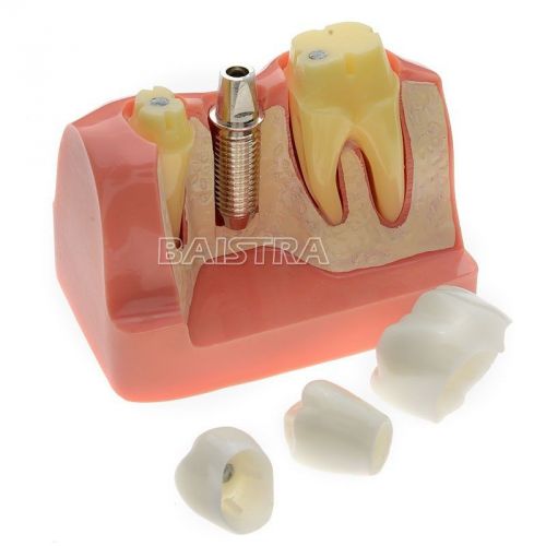 Free Shipping 1 Pc New Dental Implant Analysis Model For Study or Teach #2017