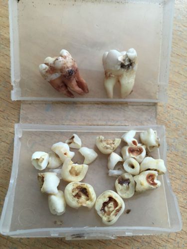 My Complete Set Of Baby Teeth &amp; 2 Wisdoms REAL &amp; RARE Must See