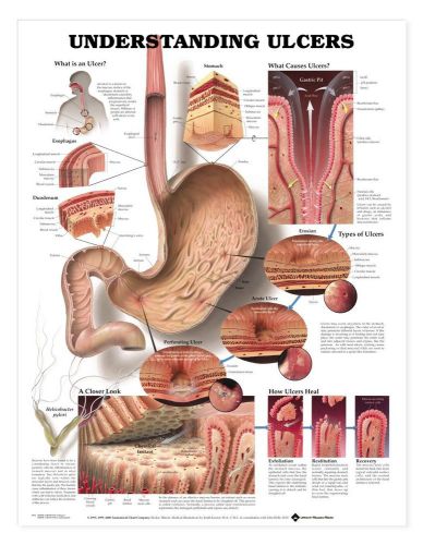 UNDERSTANDING ULCERS, LAMINATED ANATOMICAL CHART, 20 X 26