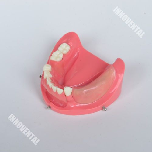 Dental Model #2003 01 - Lower Jaw Implant Practice Model (Replaceable)