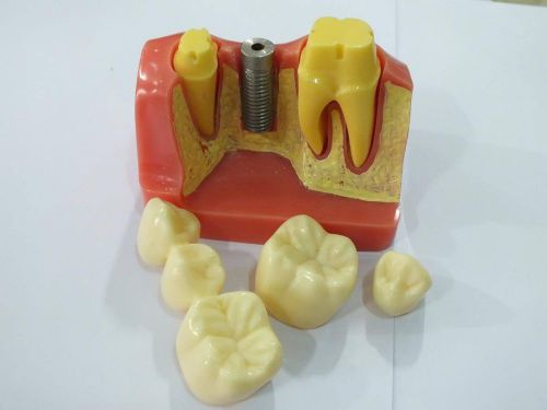 Dental teeth Implant model with Bridge and Implant Removable