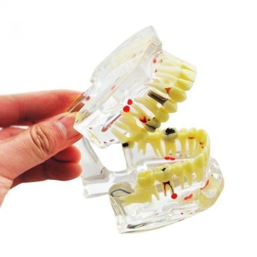 2015 dental teeth tooth transparent adult pathological model to student study for sale