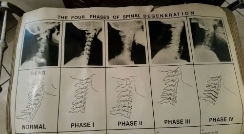 Chiropractic Four  phases of spinal degeneration poster Used
