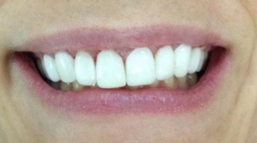 Dental Porcelain Crown Emax