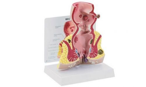 NEW Anatomical Human Rectum Cancer  Model