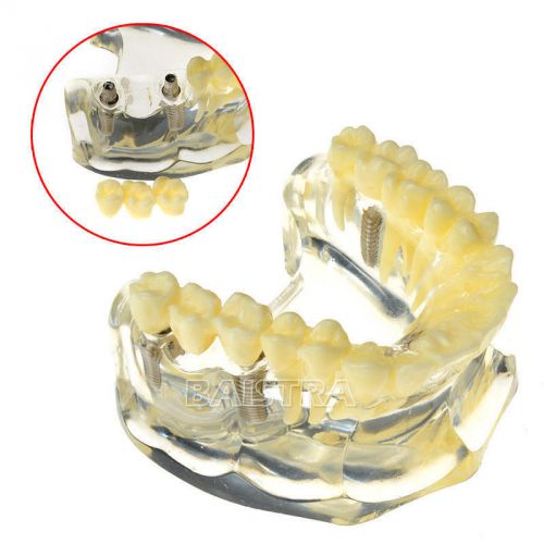 NEW 1 PC Dental Implant Demonstration Model Teeth Study #6008