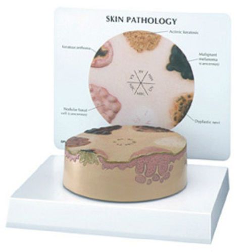 New anatomical human skin cross section cancer  model for sale