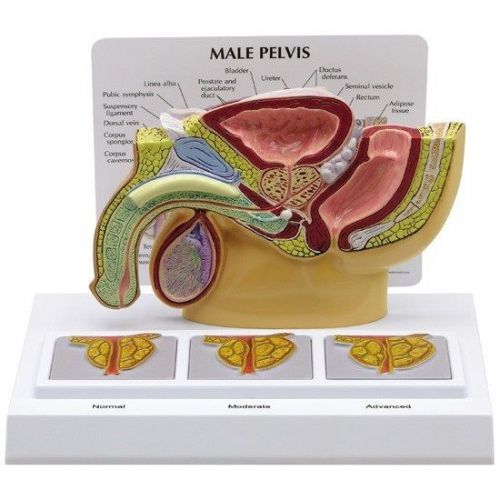 NEW GPI Anatomical Male Pelvis with 3D Enlarged Prostate Model 3551
