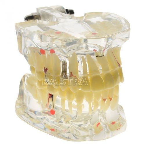 1 Pc Dental Study Tooth Transparent Adult Pathological Teeth Tooth Model #4001-I