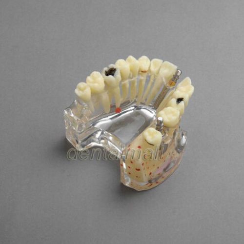 New Dental Model #2007 01 - Upper Jaw Implant Model with Bridge and Caries -II