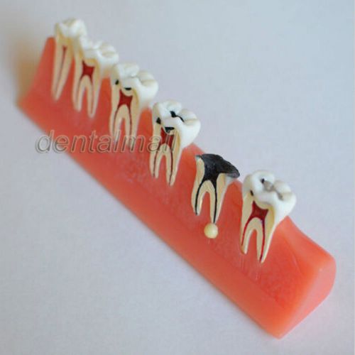 Dentalmall Dental Model #4011 01 - Caries Illustration Model