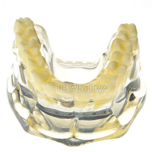 1 Pc Dental Implant Demonstration Model Teeth Study #6008 Free Shipping