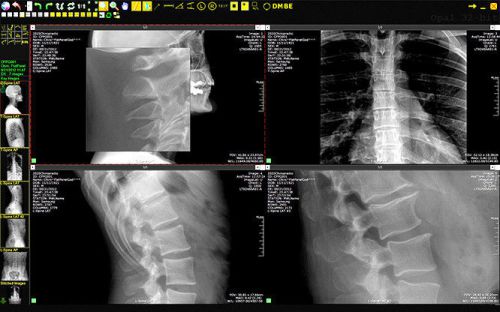 Chiropractic dr digital xray system with opal chiro software &amp; 3 year warranty! for sale