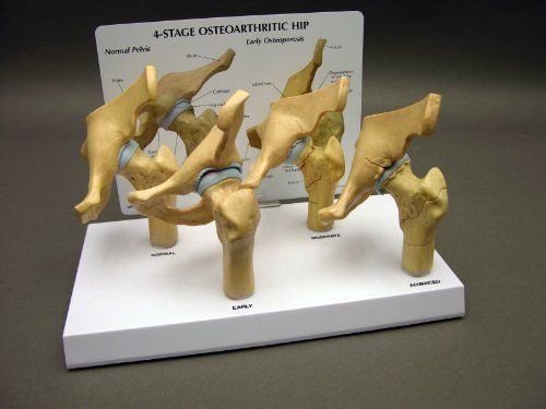 NEW Hip Joint Arthritic 4-stage Model Set