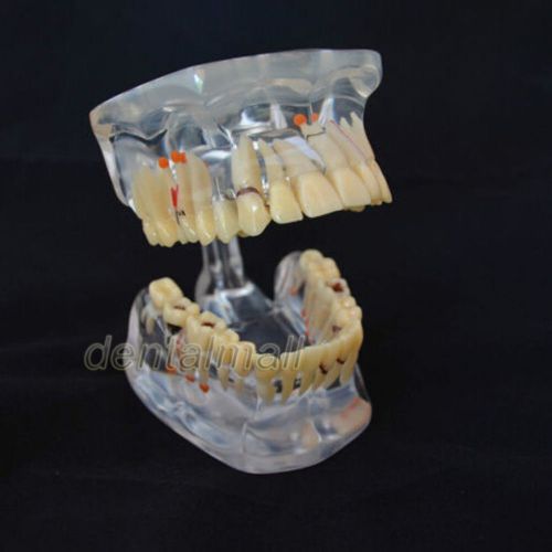 Dentalmall Dental Model #4001 02 - Adult Pathology Model