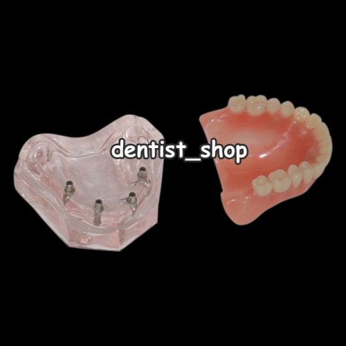 Dental Overdenture Model Superior with 4 Implants Demo Tooth Model