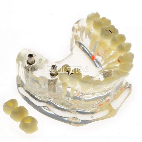 Dental Dentist Teeth Study Implant Model Bridge and Caries #2006